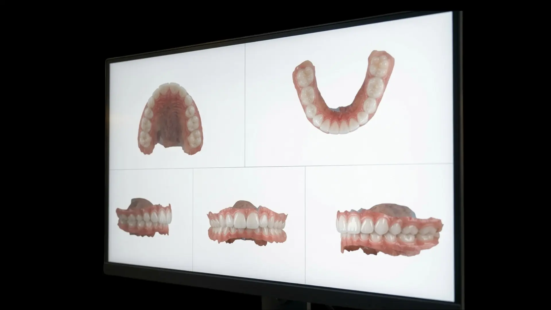 Bildschirm mit digitalen 3D-Modellen von Ober- und Unterkiefer für die Planung beim Digital Smile Design
