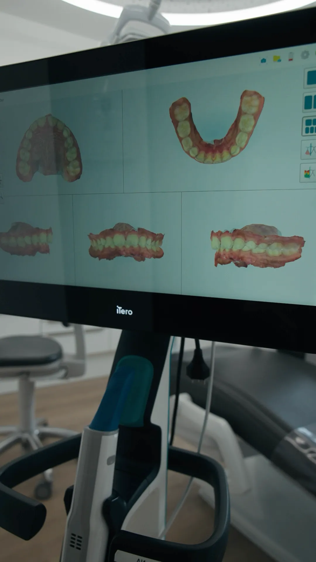 3D scan of the upper and lower jaw in several views on the iTero scanner screen