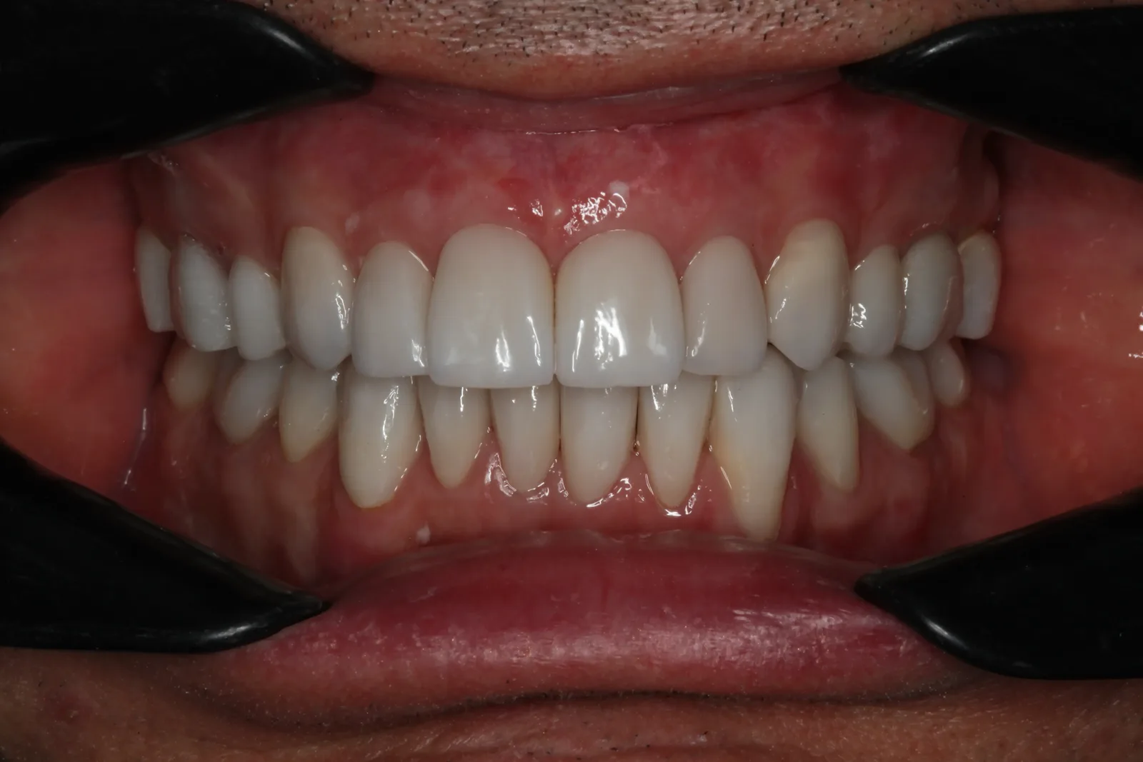 Keramik-Veneers, Fall 1 nachher: gleichmässig helle Frontzähne