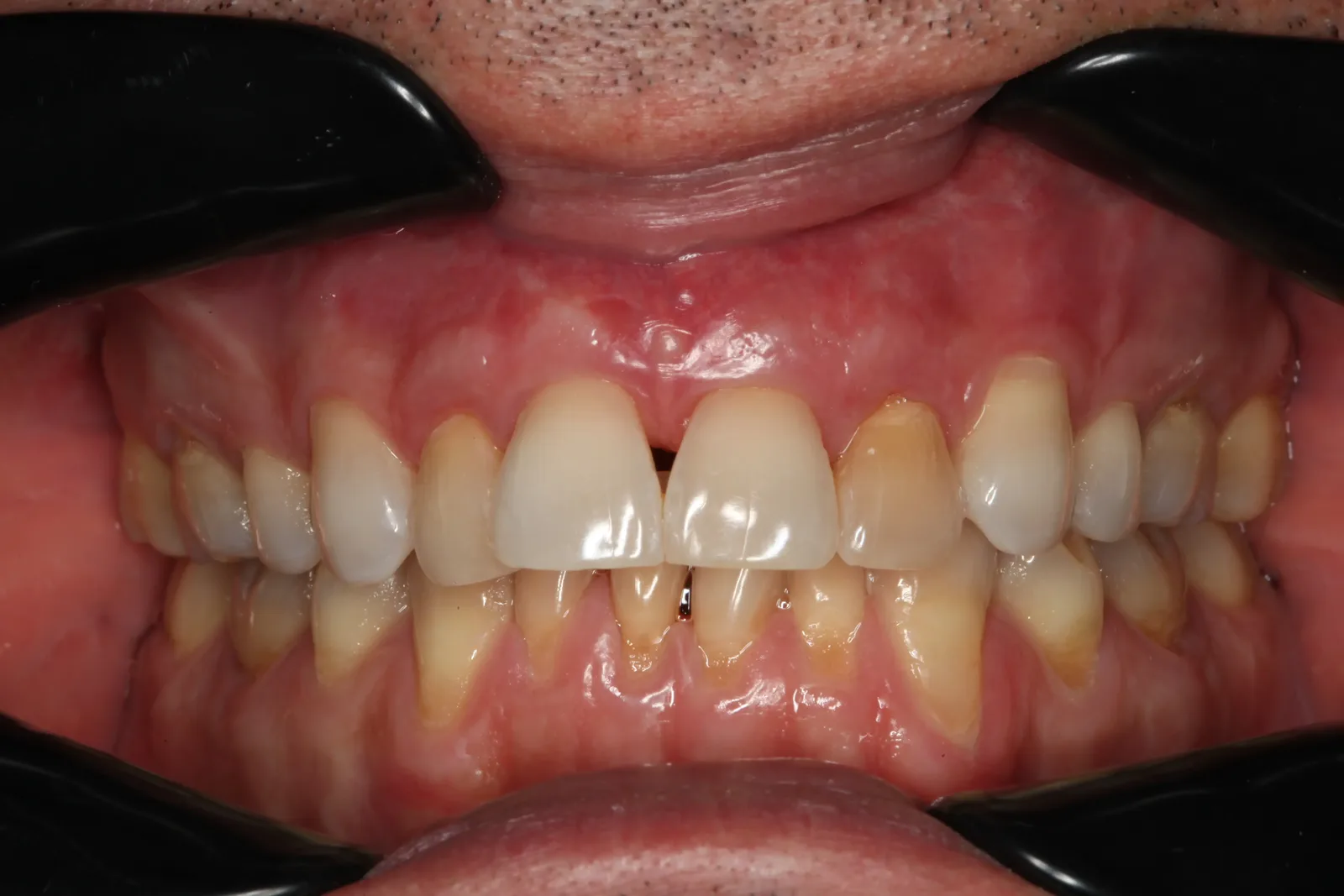 Keramik-Veneers, Fall 1 vorher: Frontzähne mit Verfärbungen und dunklen Zwischenräumen