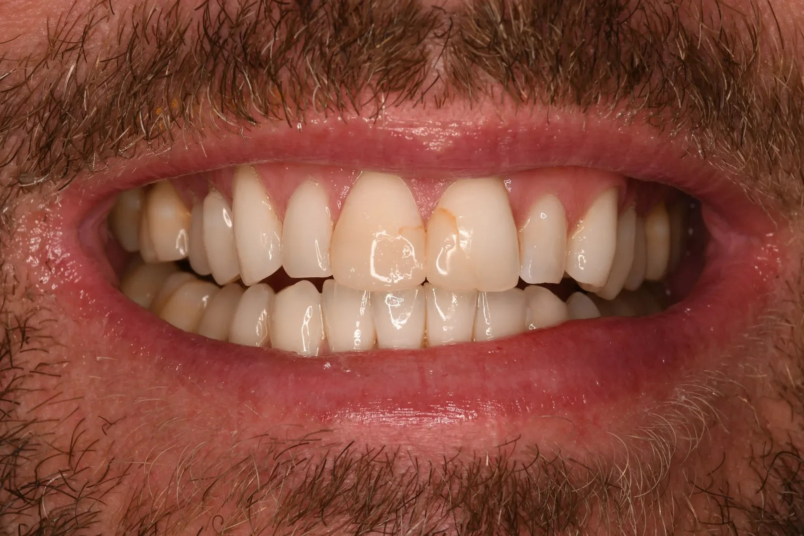 Keramik-Veneers, Fall 2 vorher: ungleichmässige, teils verfärbte Frontzähne