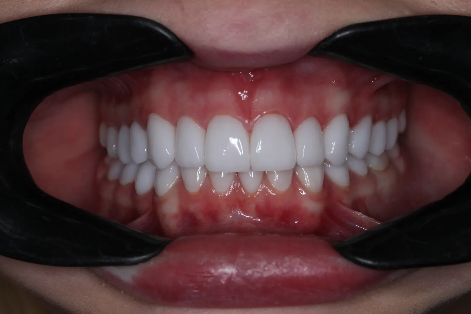 Keramik-Veneers, Fall 3 nachher: helle, gleichmässig geformte Frontzähne