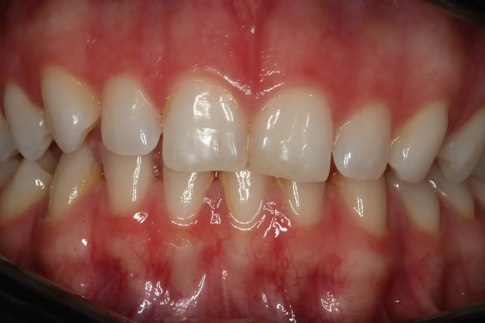 Keramik-Veneers, Fall 3 vorher: leicht verschachtelte, gelbliche Frontzähne