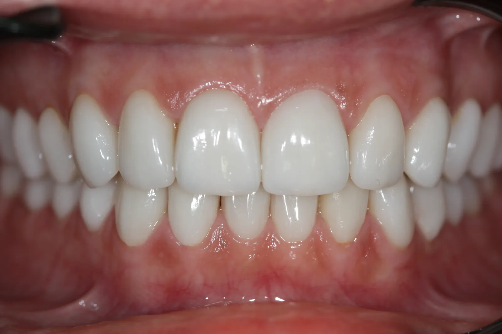 Keramik-Veneers, Fall 4 nachher: helle Frontzähne mit gleichmässigen Schneidekanten