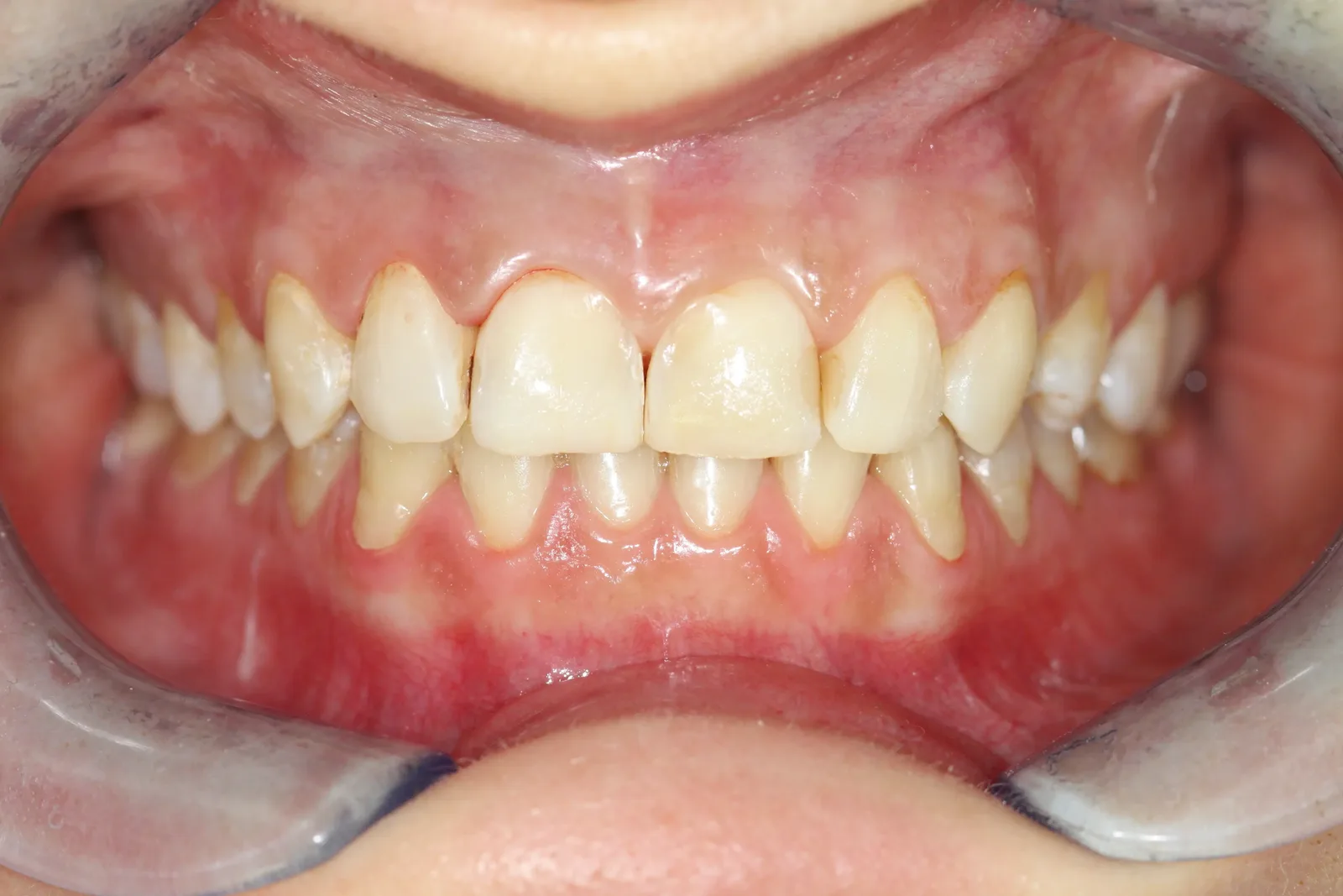 Keramik-Veneers, Fall 4 vorher: gelbliche Frontzähne mit unregelmässigen Schneidekanten
